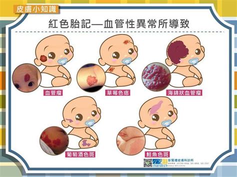 嬰兒 胎記|胎記怎麼產生、何時消除？醫師剖析胎記種類、胎記寓意